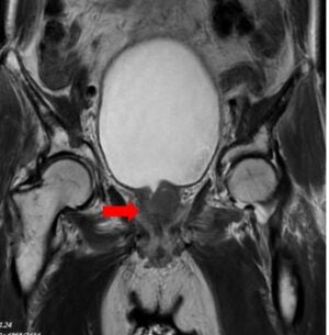 Hình 3. Hình ảnh cộng hưởng từ: Tuyến tiền liệt kích thước không to, xâm lấn túi tinh 2 bên (mũi tên đỏ)